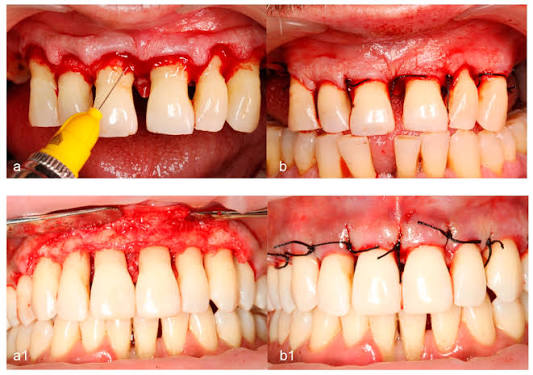 Gum Flaps Between Teeth: Causes, Risks, and Treatment Options